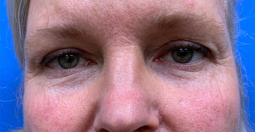 Eyelid and Upper Facial Surgery