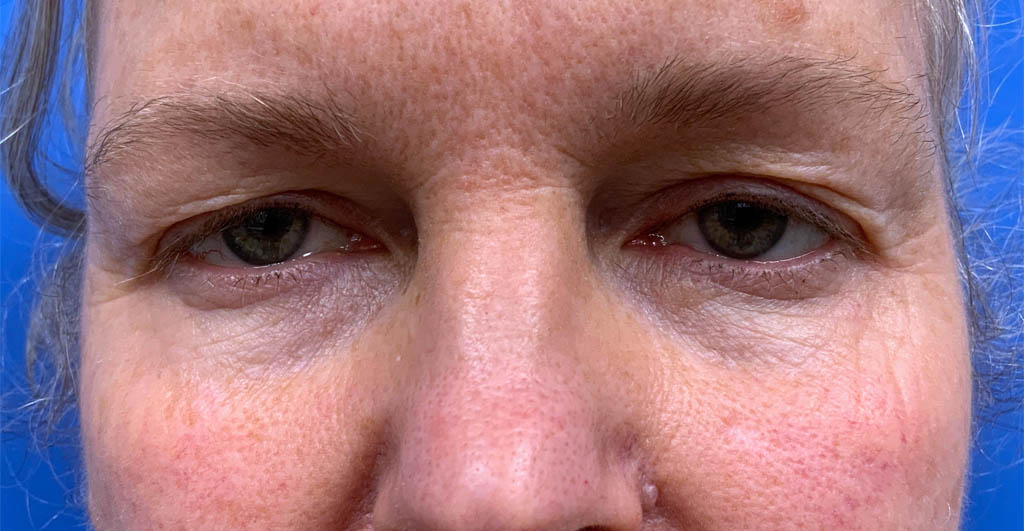 Eyelid and Upper Facial Surgery