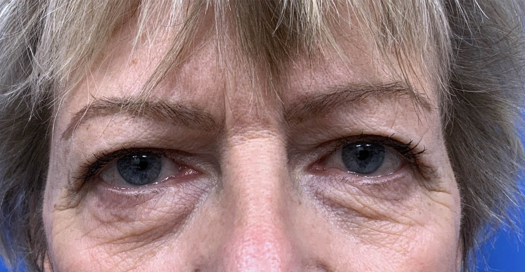 Eyelid and Upper Facial Surgery