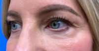 Eyelid and Upper Facial Surgery
