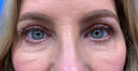 Eyelid and Upper Facial Surgery