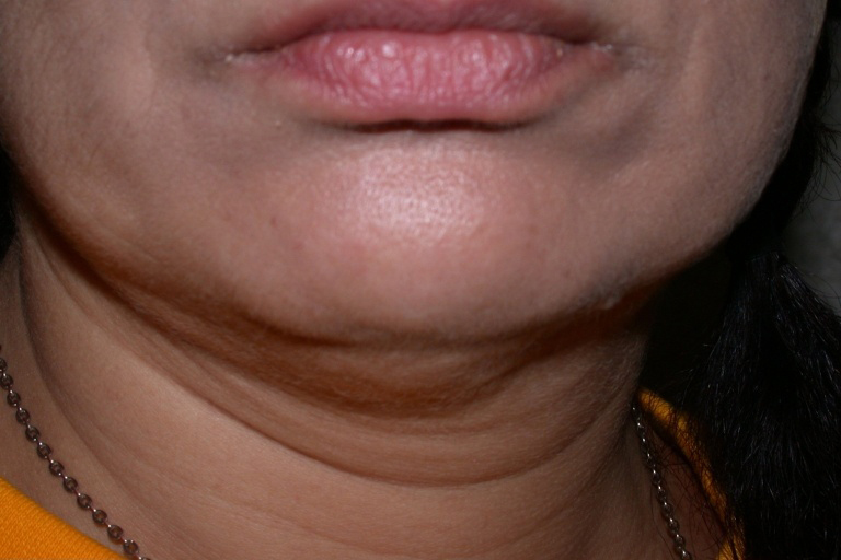 3543-92572